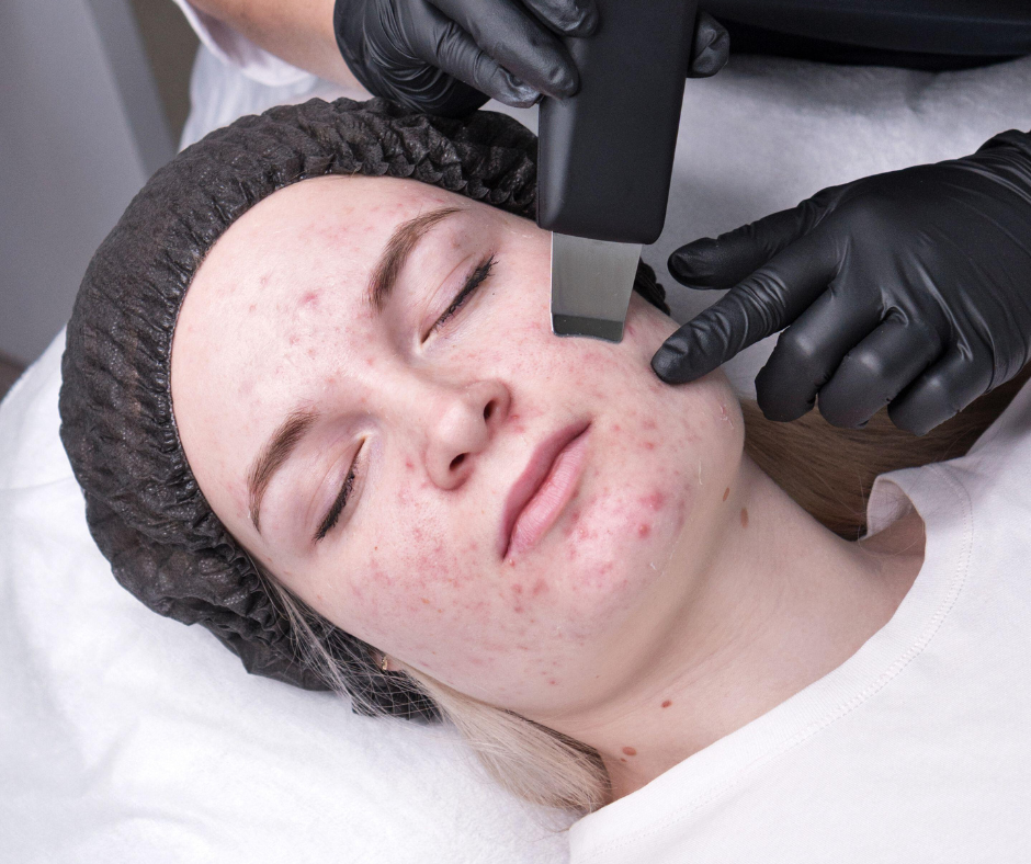 Peeling ultrassônico aplicado no rosto de uma paciente durante tratamento de acne